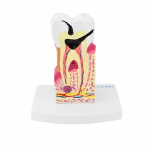 TOOTH MODEL WITH DISEASES