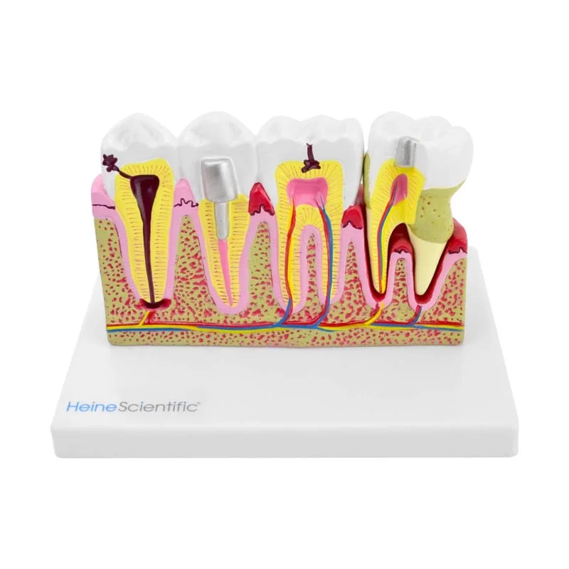 139029 dentalmodell mit erkrankung11