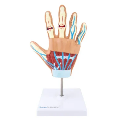 139057 handmodell arthritis 2